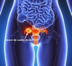 Sinais e sintomas do câncer de ovário