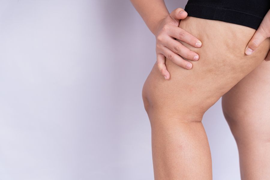 Lipedema nas pernas: o que é, causas, sintomas e tratamento
